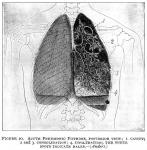 Figure 20. Acute Pneumonic Phthisis.
