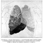 Figure 19. Lobar Pneumonia.